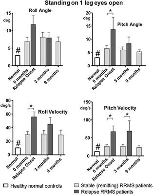 Balance Changes in Patients With Relapsing-Remitting Multiple Sclerosis: A Pilot Study Comparing the Dynamics of the Relapse and Remitting Phases